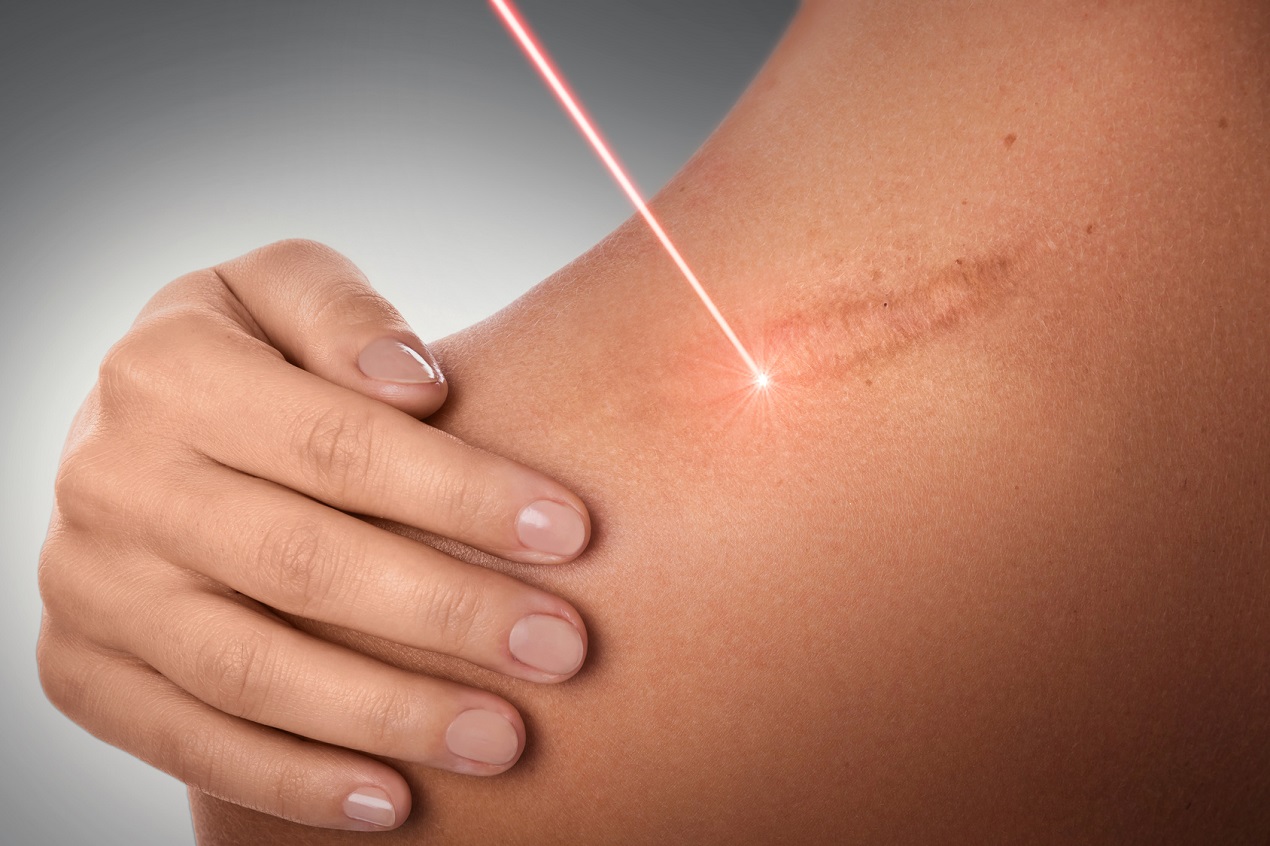 cicatrice chirurgie laser